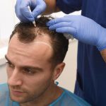 What to Expect From Getting A Hair Transplant in Istanbul