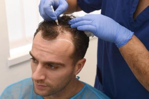What to Expect From Getting A Hair Transplant in Istanbul