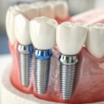 Things to Consider If You Want Dental Implants Abroad