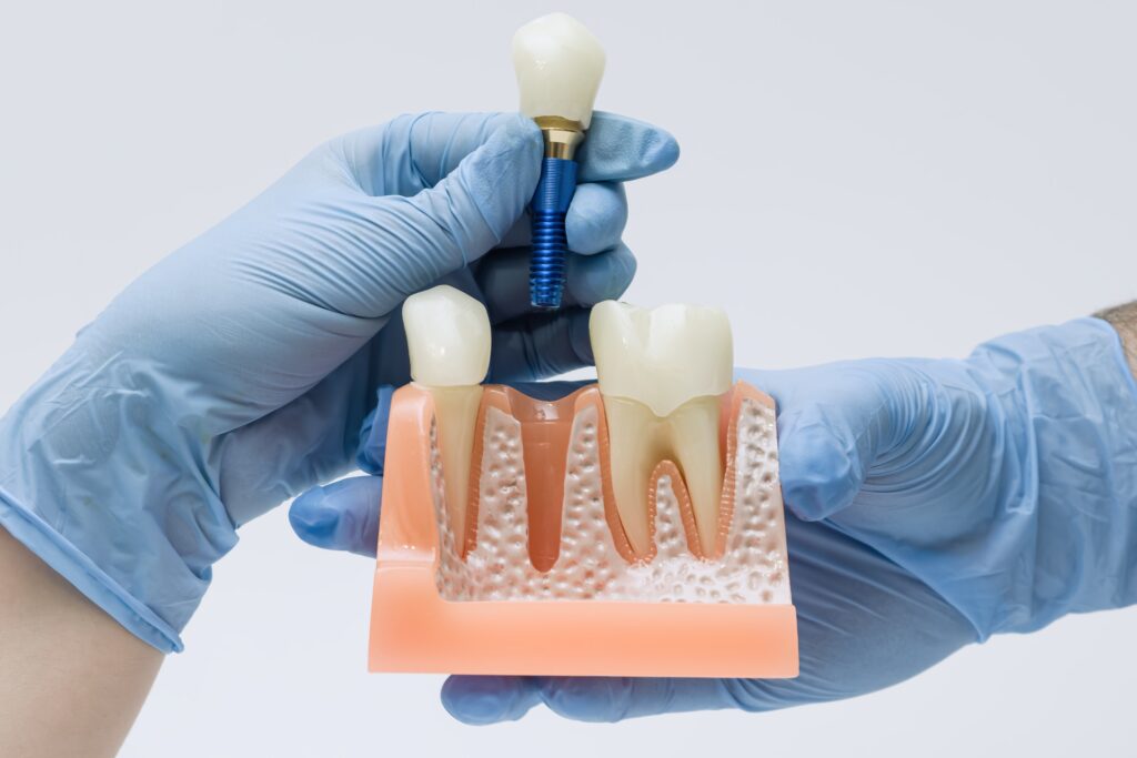Important Factors to Consider Ahead of You Have Teeth Implants Abroad
