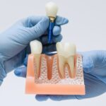 Important Factors To Consider Ahead Of You Have Teeth Implants Abroad
