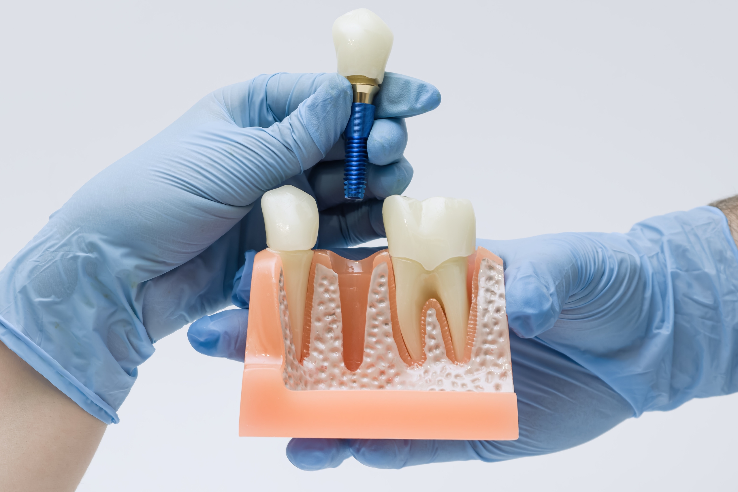 Important Factors to Consider Ahead of You Have Teeth Implants Abroad